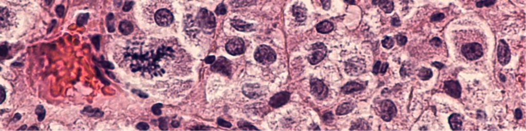 Skin cancer treatment Newport Beach, CA