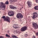 Skin Cancer Newport Beach, CA - ZENA Medical | Newport Beach Skin cancer treatment Newport Beach, CA