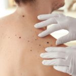 Skin Cancer Newport Beach