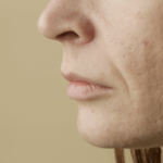 Microneedling Newport Beach