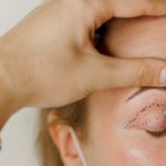 Blepharoplasty Newport Beach