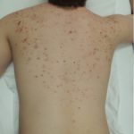 Rosacea Newport Beach