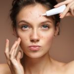 Newport Beach Acne Treatment