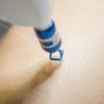 CO2 laser newport beach