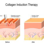 microneedling newport beach