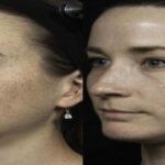HYPERPIGMENTATION