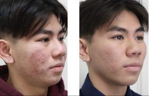 Acne treatment before and after photos