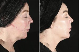 xerf-before-after-full-face-skin-tightening