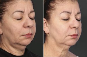 XERF skin tightening before and after jawline improvement showing firmer contour in Newport Beach