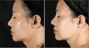 before and after XERF treatment for jowls showing improved skin firmness and lifted appearance in Orange County