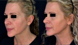 XERF radiofrequency skin tightening results