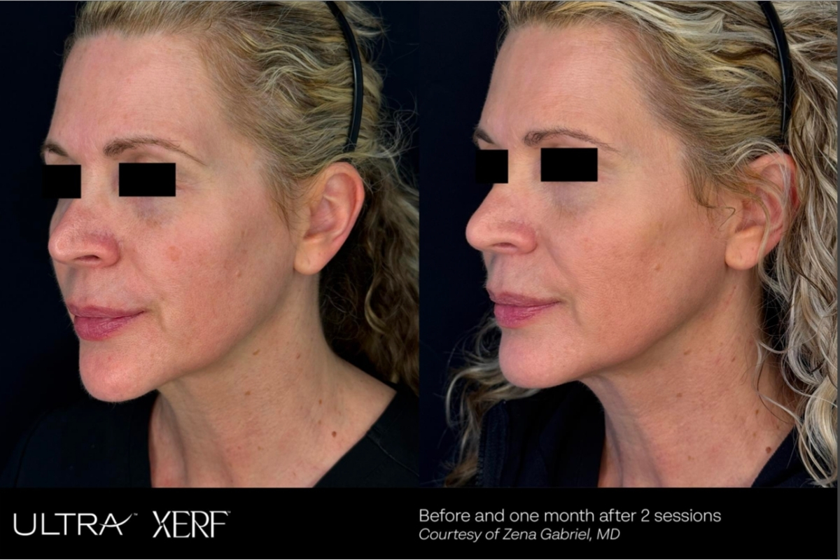 XERF radiofrequency skin tightening results