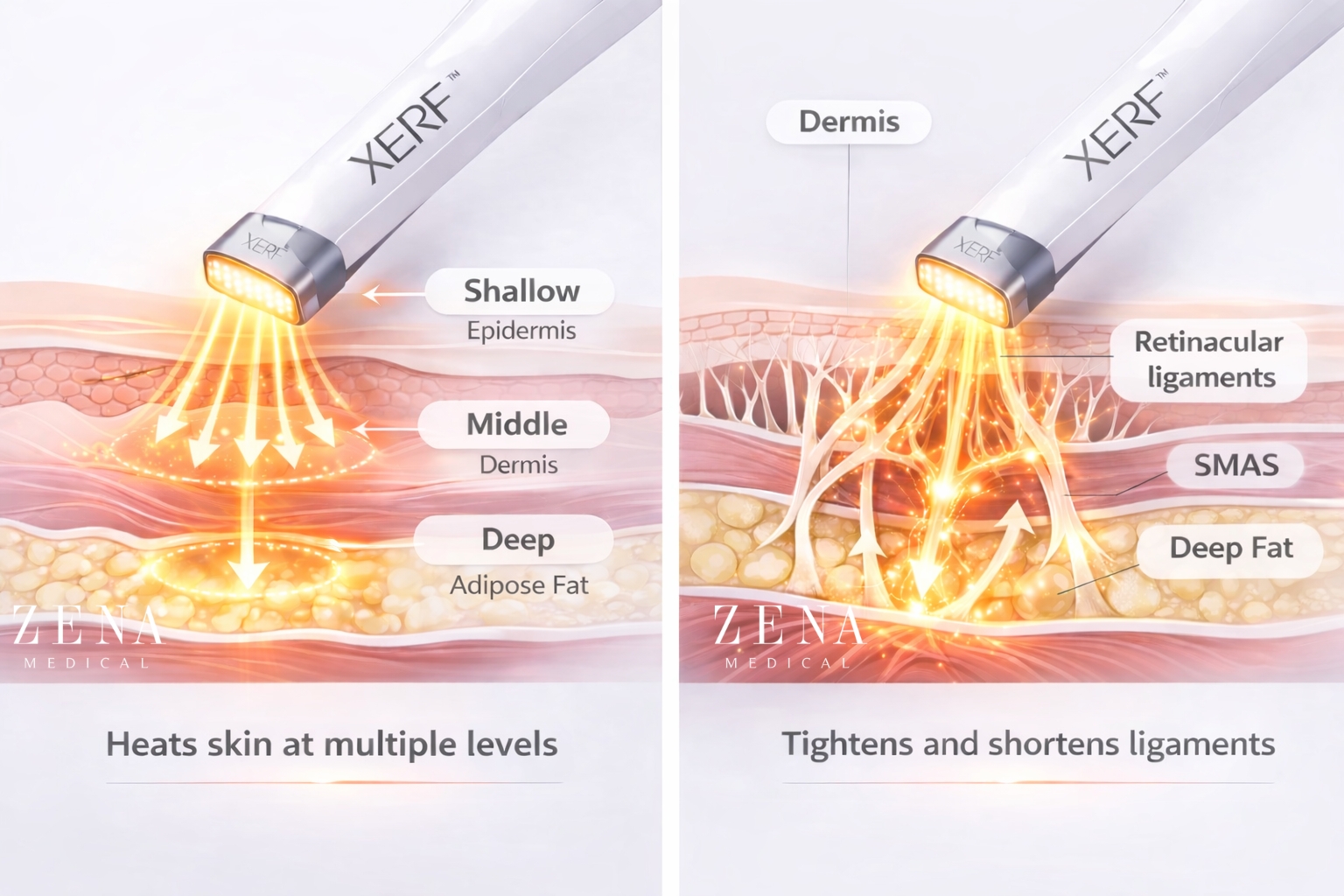 XERF radiofrequency skin layers diagram
