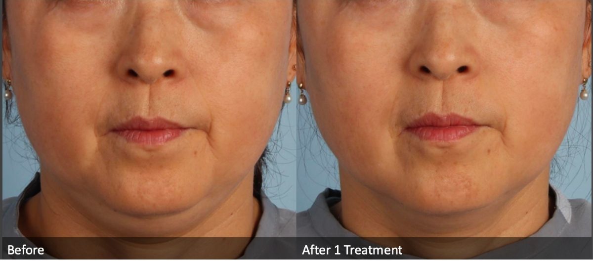 XERF skin tightening before and after jawline