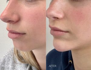 Chin filler before and after photos newport beach ca