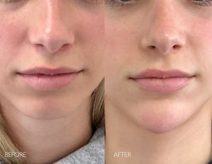 Side-by-side close-up of a woman's lower face showing before and after cosmetic treatment, highlighting a smoother jawline and chin.