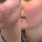 Acne treatment newport beach ca