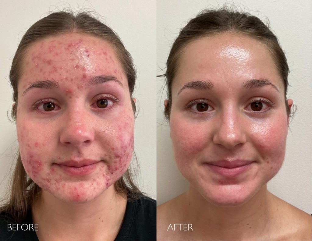 medical acne treatment newport beach ca