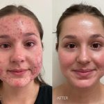 medical acne treatment newport beach ca