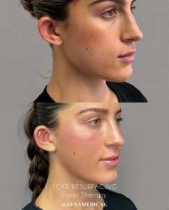 Before and after laser resurfacing for acne scars at ZENA Medical in Newport Beach