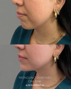 Before and after chin filler at ZENA Medical in Newport Beach