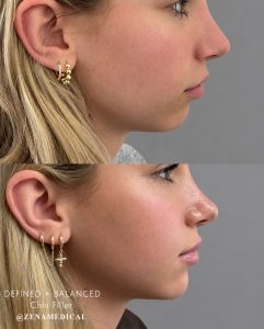 Before and after chin filler, side profile, at ZENA Medical in Newport Beach