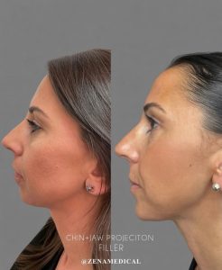 Before and after chin and jawline filler, side profile, at ZENA Medical in Newport Beach