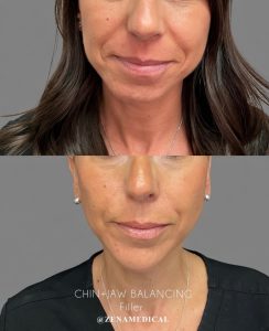 Before and after chin and jawline balancing with filler at ZENA Medical in Newport Beach