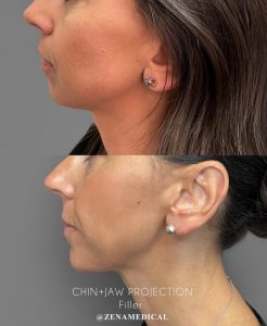 Before and after chin and jaw projection with filler at ZENA Medical in Newport Beach