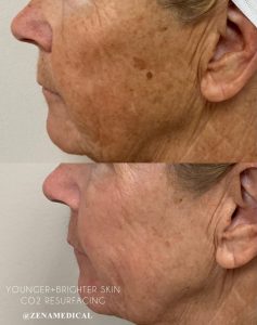 Before and after CO2 laser resurfacing for sun damage and wrinkles at ZENA Medical in Newport Beach