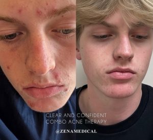 Before and after combination acne therapy at ZENA Medical in Newport Beach