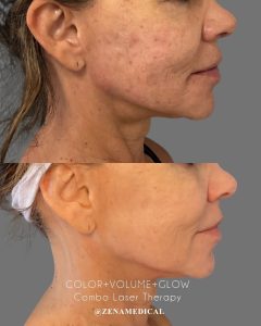 Before and after combination laser therapy with Mosaic, XERF and Vbeam at ZENA Medical in Newport Beach
