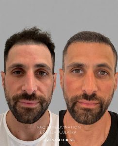 Before and after facial rejuvenation with PRF EZGel and Sculptra, front view, at ZENA Medical in Newport Beach