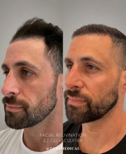 Before and after facial rejuvenation with PRF EZGel and Sculptra, angled view, at ZENA Medical in Newport Beach