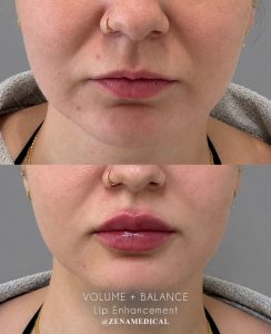 Before and after lip filler for volume and balance at ZENA Medical in Newport Beach