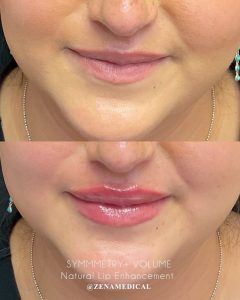 Before and after natural lip enhancement with filler at ZENA Medical in Newport Beach