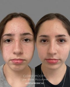 Before and after low-dose Accutane acne treatment, front view, at ZENA Medical in Newport Beach