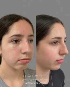Before and after low-dose Accutane acne treatment, angled view, at ZENA Medical in Newport Beach