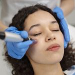 Microneedling cost in Newport Beach, ca