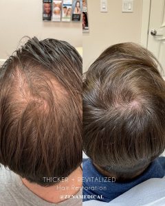 Before and after PRP hair restoration at the crown at ZENA Medical in Newport Beach