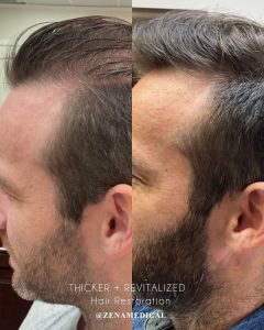 Before and after PRP hair restoration at the hairline at ZENA Medical in Newport Beach