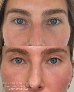 Before and after tear trough filler for dark circles at ZENA Medical in Newport Beach