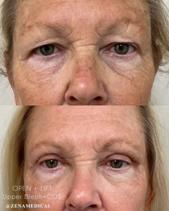 Before and after upper eyelid surgery with CO2 laser at ZENA Medical in Newport Beach