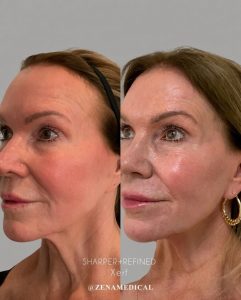 Before and after XERF skin tightening of the jawline and lower face at ZENA Medical in Newport Beach